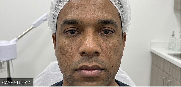 Botox After