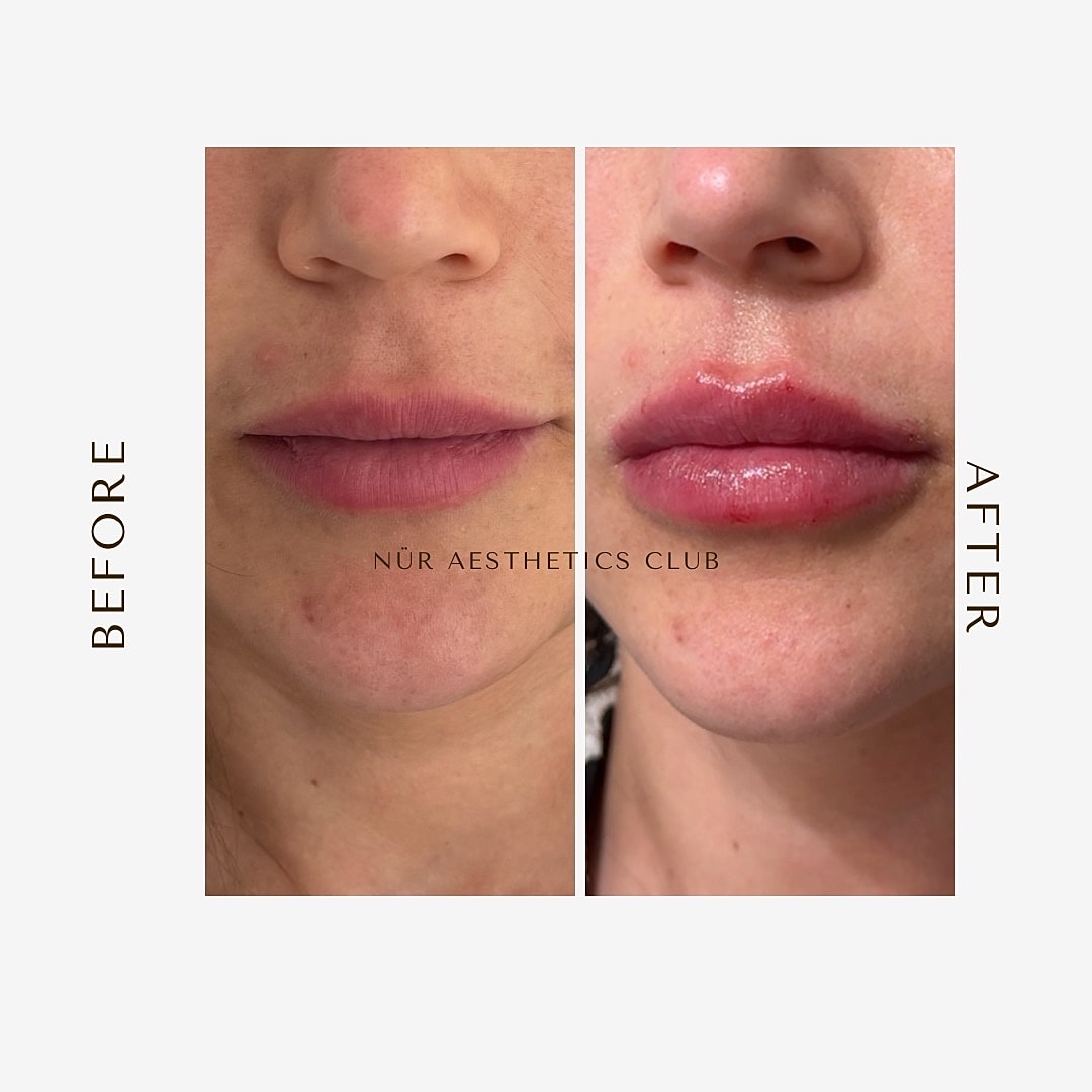 Lip enhancement before and after comparison.