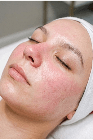 Botox Before