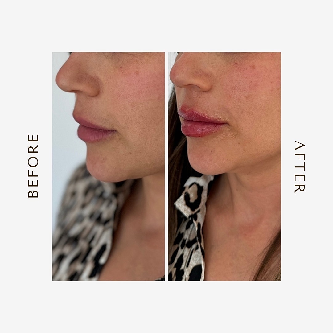 Before and after cosmetic enhancement side profile.