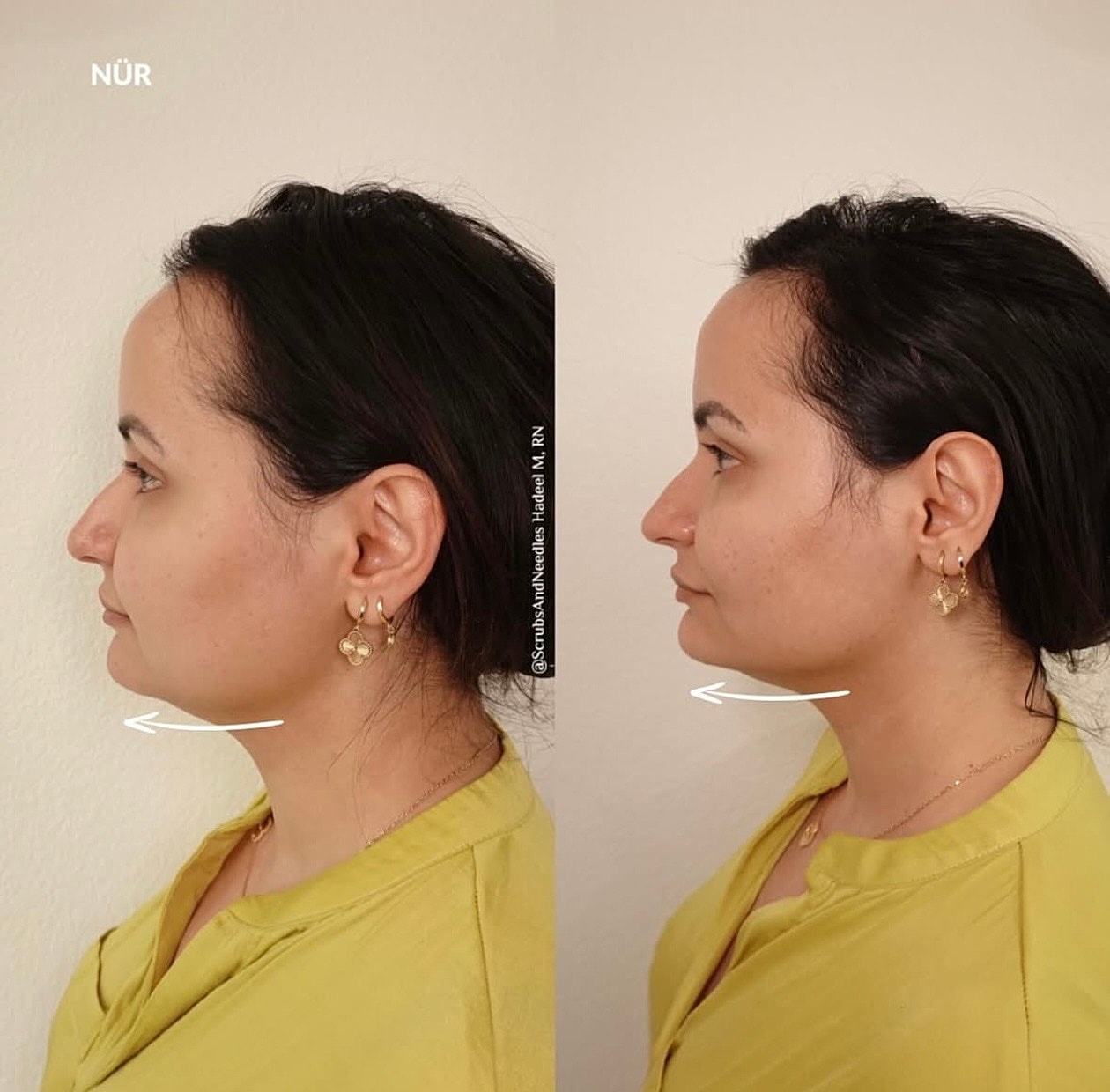 Profile comparison of facial before and after treatment.