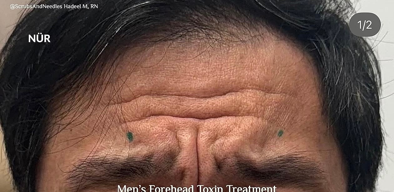 Botox After