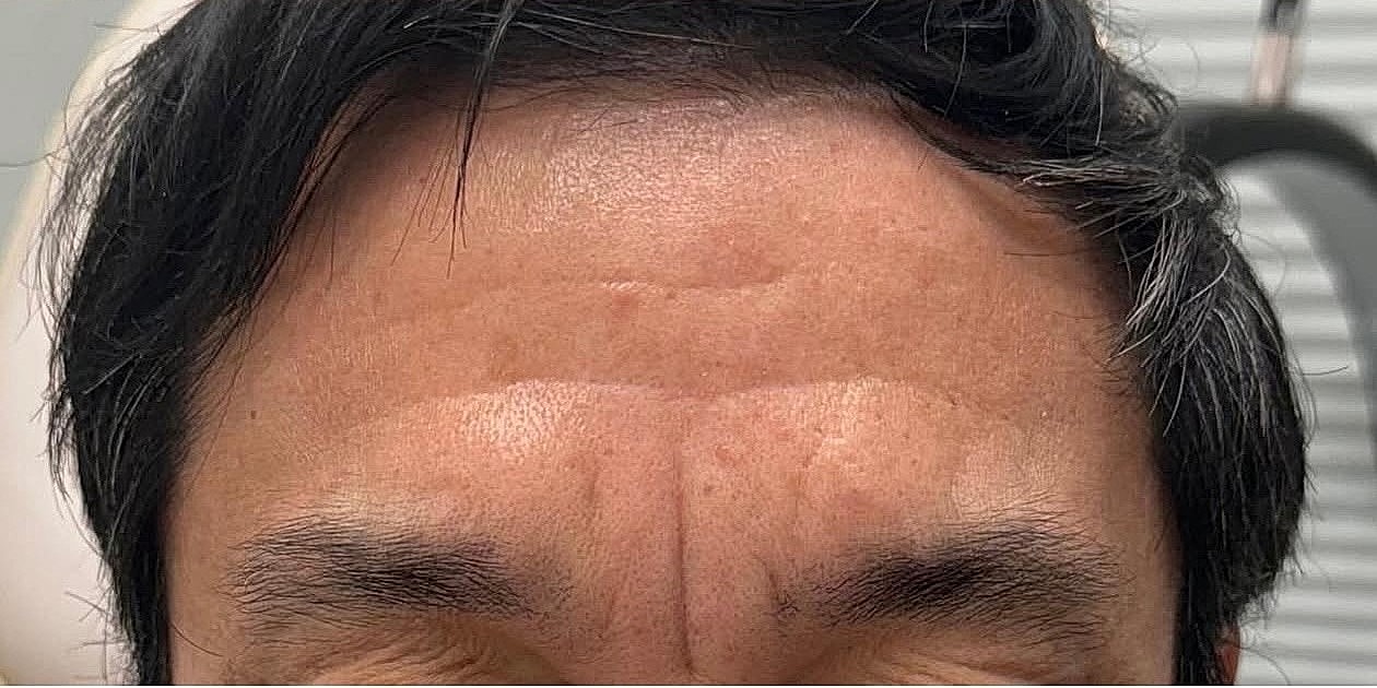 Botox Before