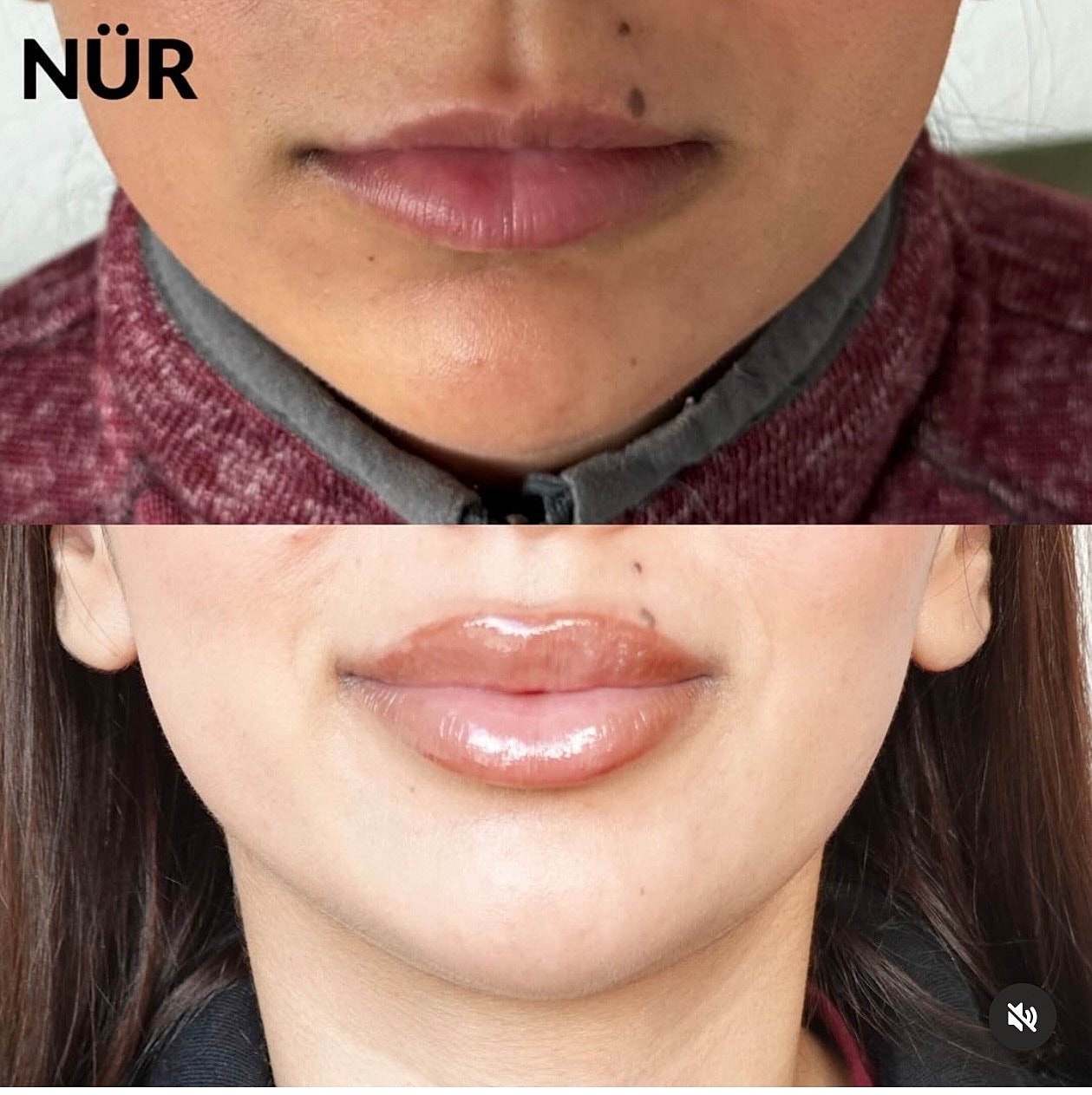 Lip transformation before and after treatment.