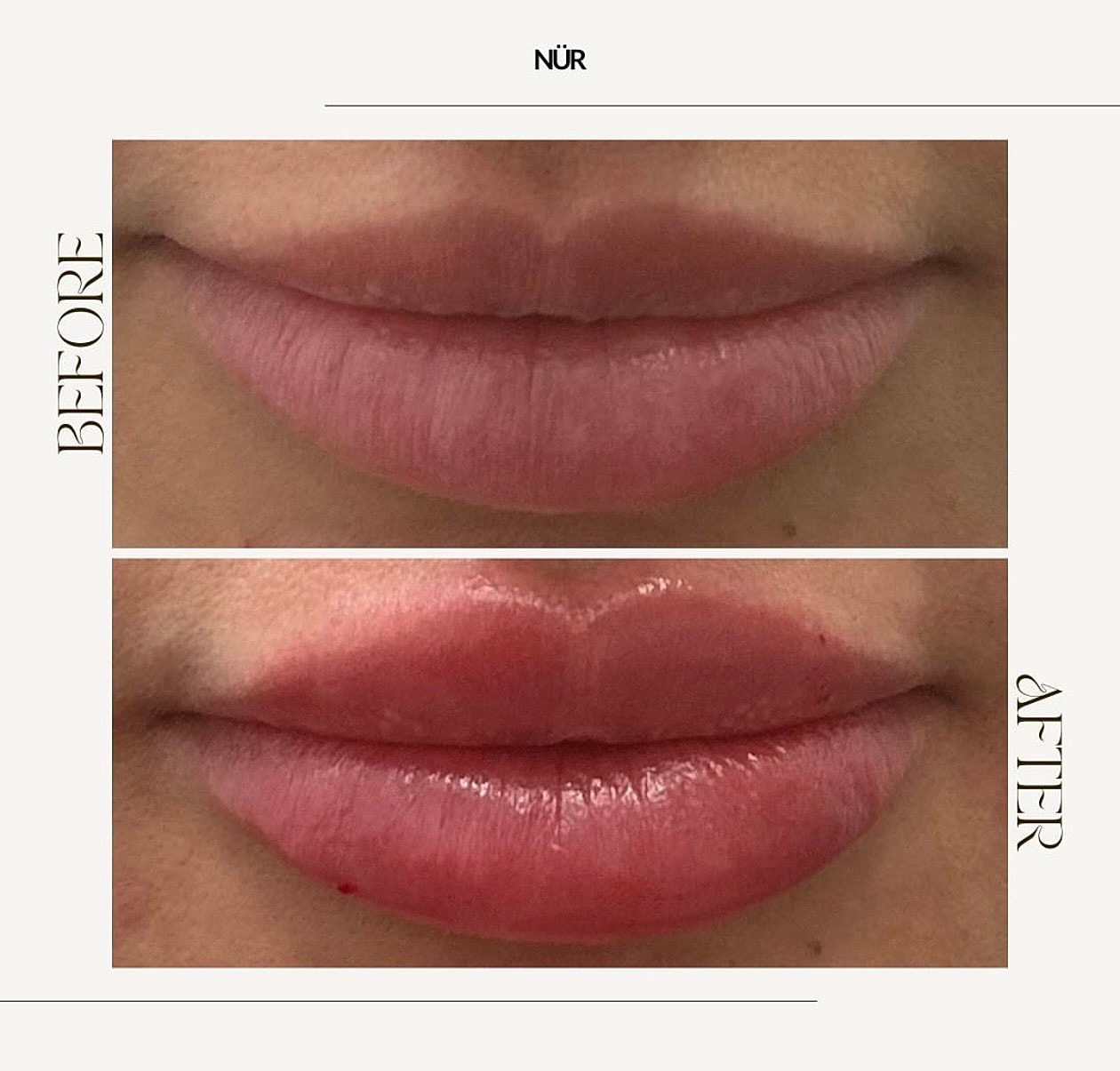 Lip enhancement before and after comparison.