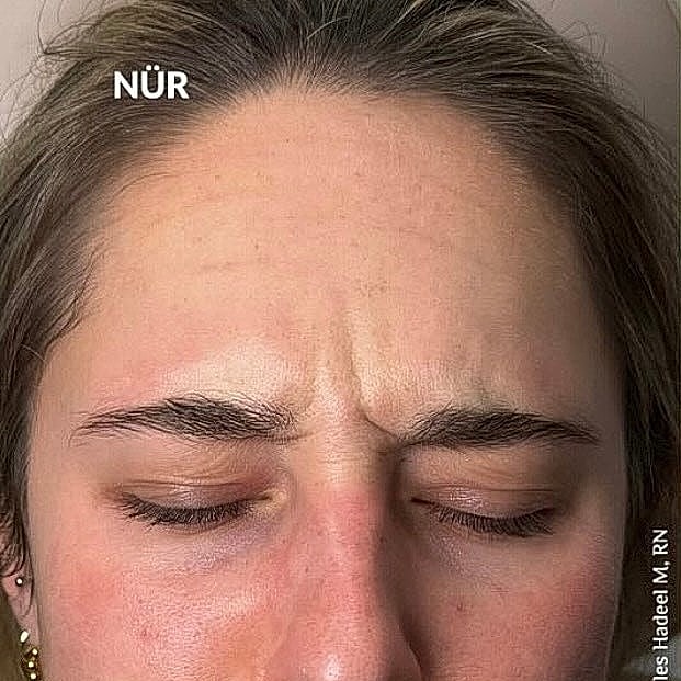 Botox After