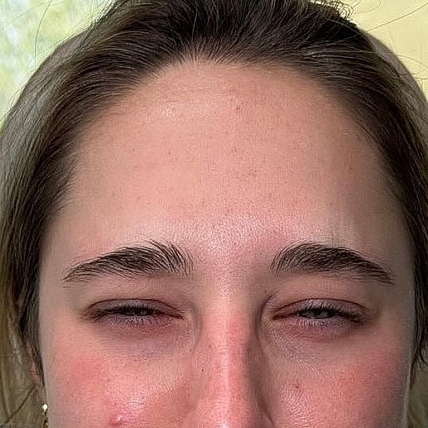 Botox Before