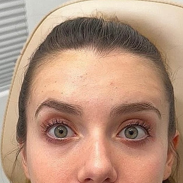 Botox Before