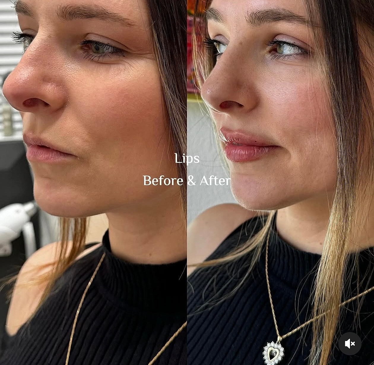 Lip enhancement before and after comparison image