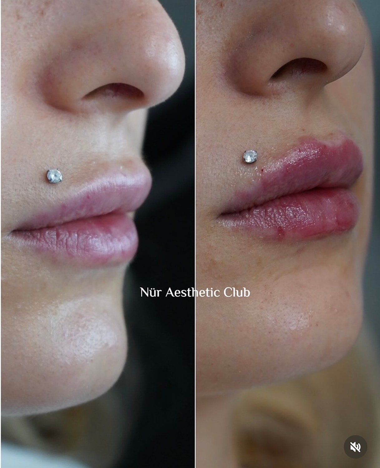 Lip enhancement comparison before and after treatment.