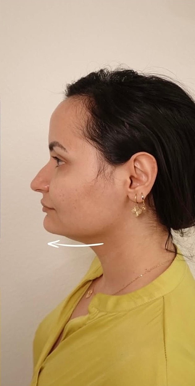 Botox Before