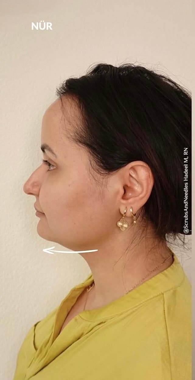 Botox After