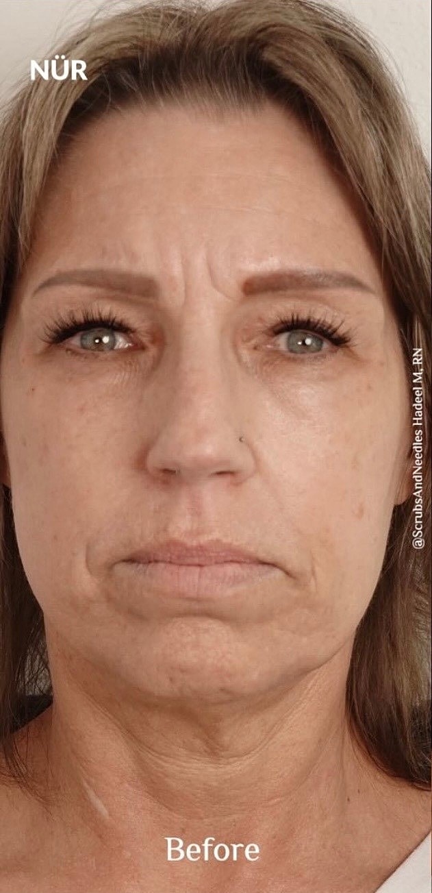 Botox After