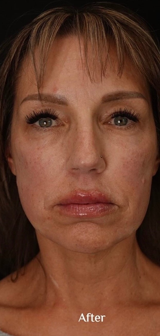 Botox Before