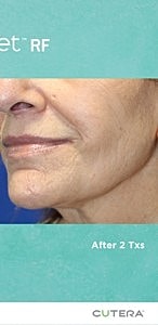 Botox Before