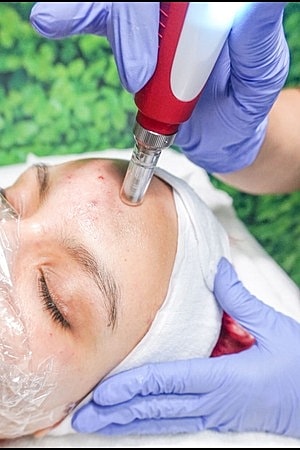 Botox After